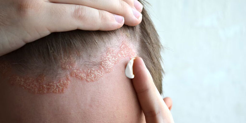 مقابله با پسوریازیس